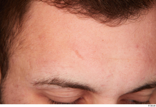 Anatoly head scar 0001.jpg